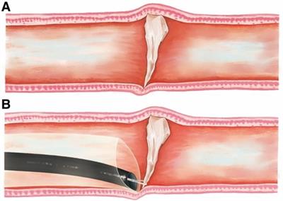 Feasibility and safety of a self-developed sleeve for the endoscopic removal of refractory foreign body incarceration
